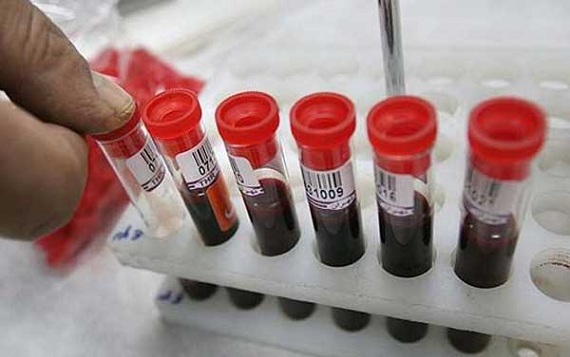 В Свердловской области объявлена эпидемия ВИЧ