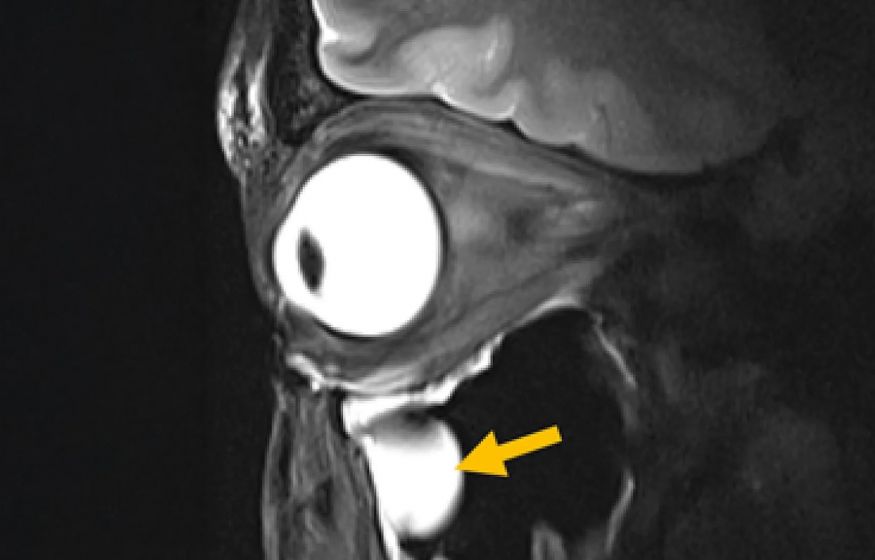 Новая MRI-антенна показывает мозг и глаза как никогда раньше