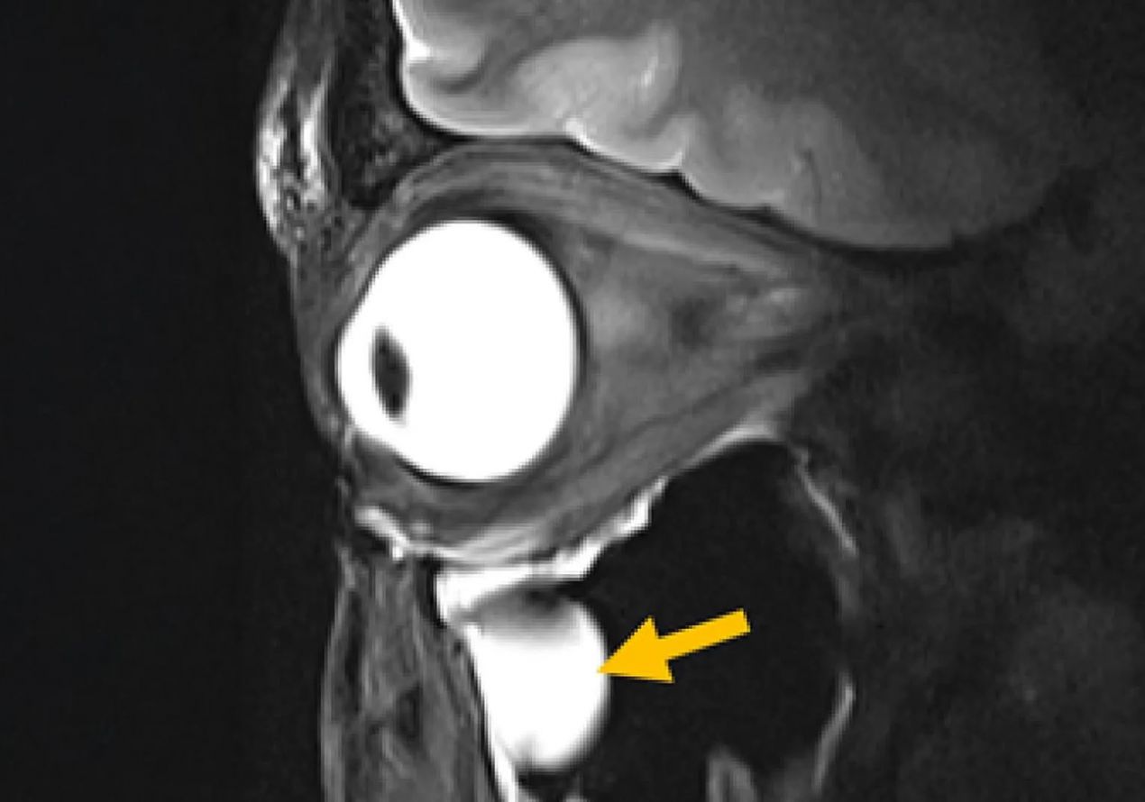 Новая MRI-антенна показывает мозг и глаза как никогда раньше